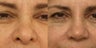 Revision rhinoplasty in a 50 year old client