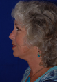 Neck Lift