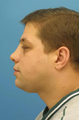 Nasal Fracture Repair