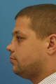 Nasal Fracture Repair
