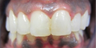 Severely Rotated Front Tooth
