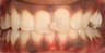Severely Rotated Front Tooth