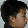 Microtia aka Small Ear by Dr Kasrai, Toronto Female Plastic Surgeon