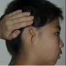 Microtia aka Small Ear by Dr Kasrai, Toronto Female Plastic Surgeon