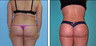 Brazilian Butt Lift Before & After