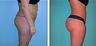 Brazilian Butt Lift Before & After