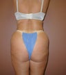 Liposuction of Posterior Flanks