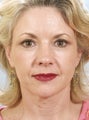 Eye lid surgery with a Facelift