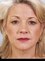 Eye lid surgery with a Facelift