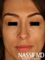 Primary Female Rhinoplasty