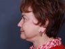 Chin Implant