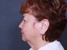 Chin Implant