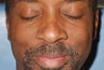 Male Patient Treated for Facial Moles