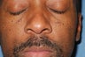 Male Patient Treated for Facial Moles