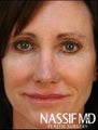 Female Revision Rhinoplasty