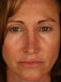 Female Revision Rhinoplasty