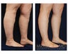 Lower Leg Liposuction
