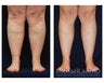 Lower Leg Liposuction