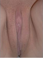 Labiaplasty surgery