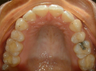 Invisalign treatment for rotated, uneven teeth