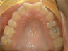 Invisalign treatment for rotated, uneven teeth