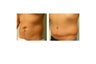 abdominoplasty