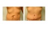 abdominoplasty