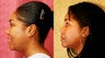African American Rhinoplasty