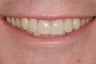 Restoration of severely worn incisors with ceramic crowns.