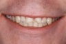 Restoration of severely worn incisors with ceramic crowns.
