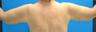 SmartLipo Before & After