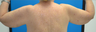 SmartLipo Before & After