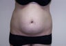 Liposculpture on abdominal fat