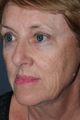 Laser Skin Resurfacing Female Patient