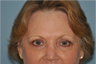 Eyelid surgery in middle aged woman