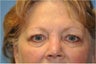 Eyelid surgery in middle aged woman