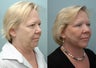 Facelift, Upper Eyelid Surgery & Fat Transfer