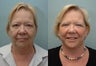 Facelift, Upper Eyelid Surgery & Fat Transfer