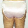 Liposuction