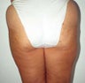Liposuction