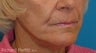 Perioral dermabrasion and a facelift