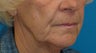 Perioral dermabrasion and a facelift