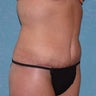 Circumferential Body Lift with Buttock Augmentation
