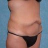 Circumferential Body Lift with Buttock Augmentation