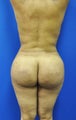 Brazilian Butt Lift