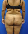 Brazilian Butt Lift