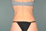 Smart Lipo