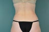 Smart Lipo