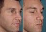 Male Patient Revision Rhinoplasty