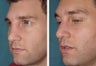 Male Patient Revision Rhinoplasty